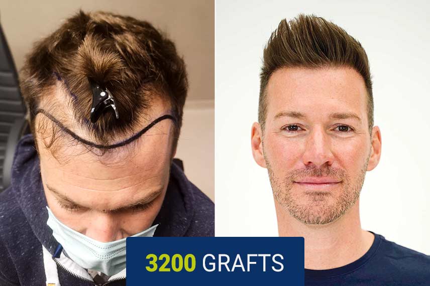 Before and after DHI hair transplant - 3200 grafts