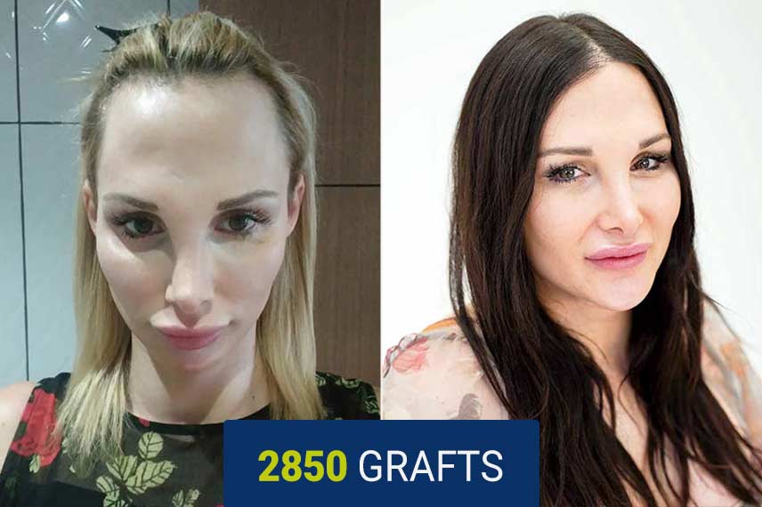 Before and after DHI hair transplant for women - 2850 grafts