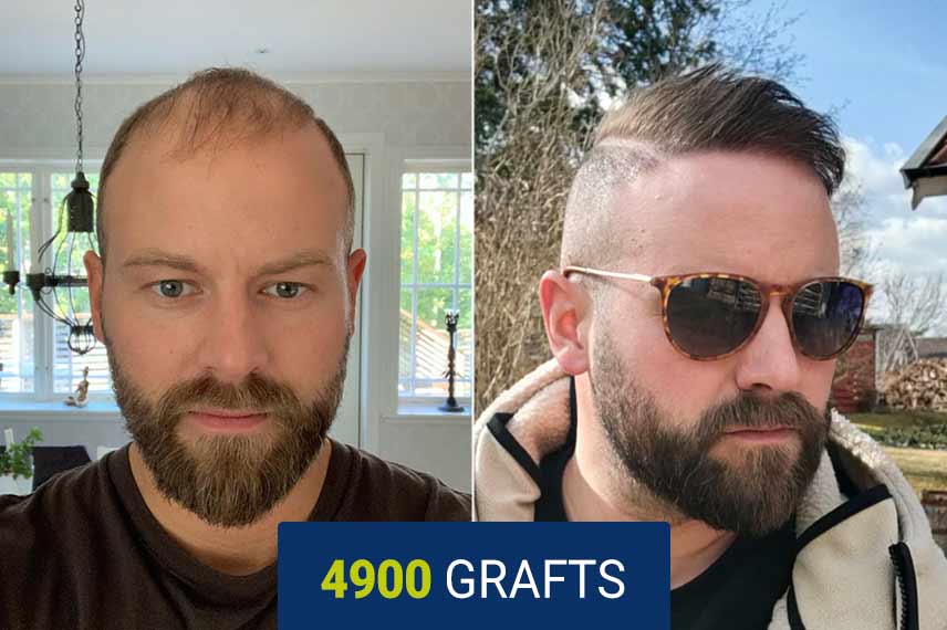 Before and after DHI hair transplant - 4900 grafts