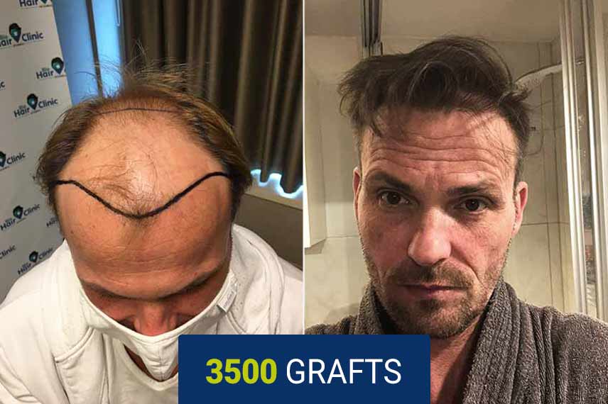 Before and after DHI hair transplant - 3500 grafts