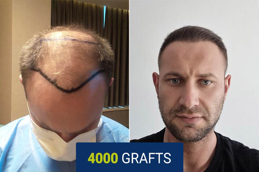 Before and after DHI hair transplant - 4000 grafts