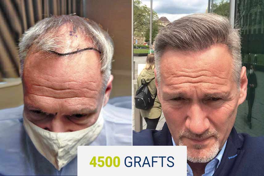 Before and after Sapphire hair transplant - 4500 grafts