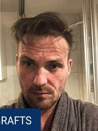 After hair transplant — 3500 grafts