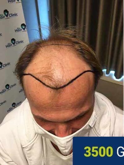 Before hair transplant — 3500 grafts