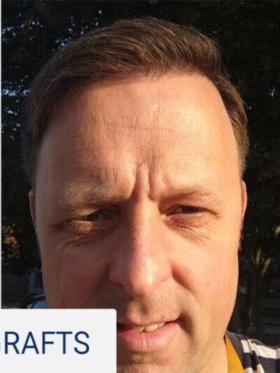 After hair transplant — 4200 grafts
