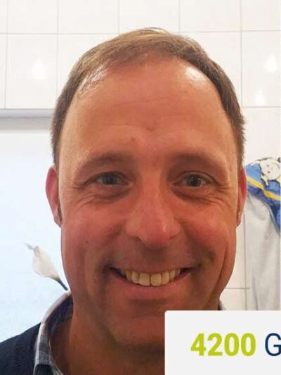 Before hair transplant — 4200 grafts