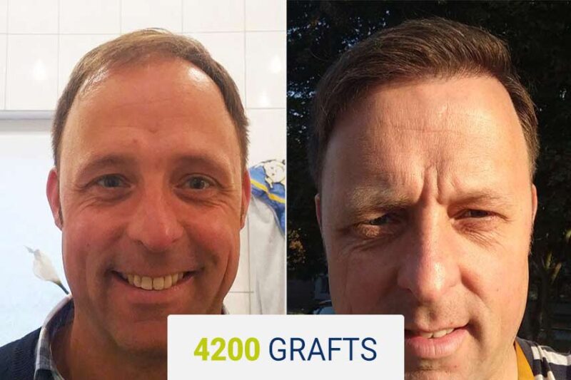 Before and after hair transplant result