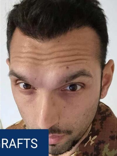 After hair transplant — 4200 grafts