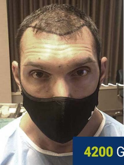 Before hair transplant — 4200 grafts