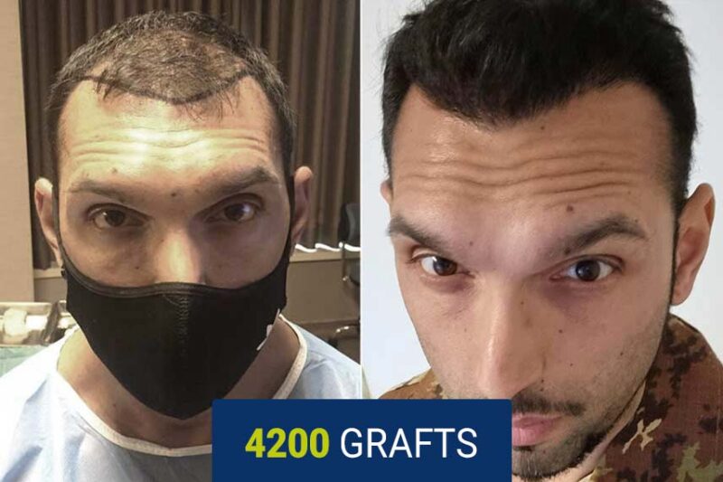 Before and after hair transplant result